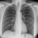 CXR (Chest X-Ray) Cases