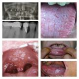 🦷عرض حالات سريريه ومناقشتها 🦷
